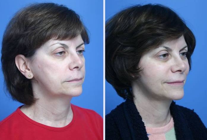 Before and After Image: 3-d volumetric facelift – case 2 - right-front-oblique