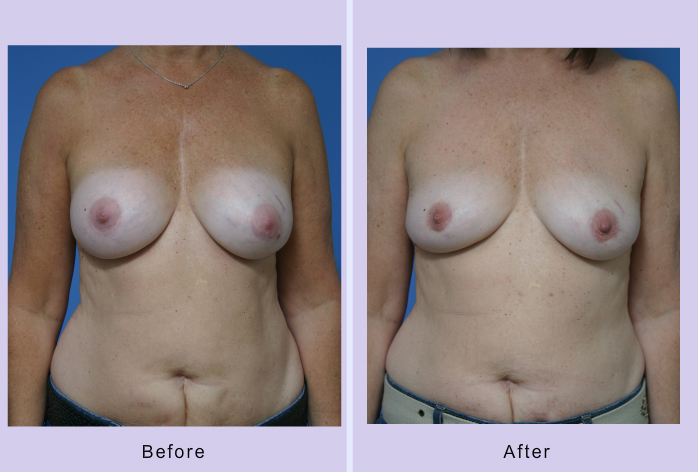 Before and After Image: breast implant removal – case 1 - front