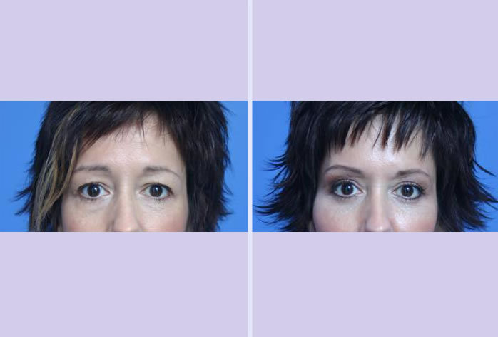Before and After Image: blepharoplasty – case 1 - front