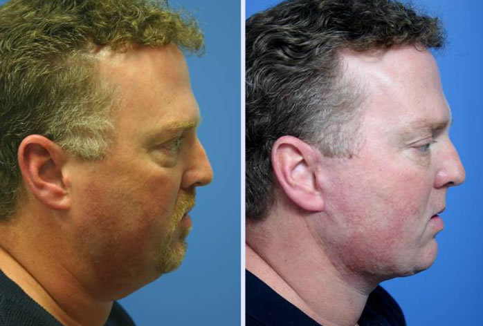 Before and After Image: 3-d volumetric facelift – case 7 - front