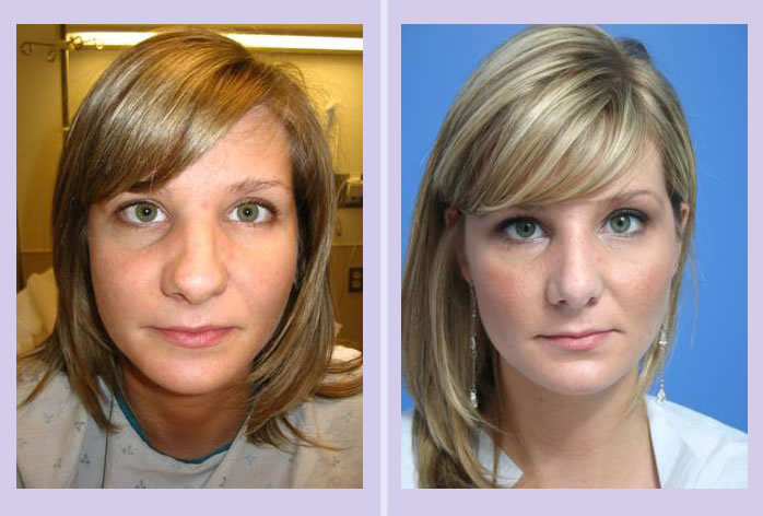 Before and After Image: rhinoplasty – case 1 - front