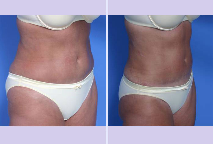 Before and After Image: liposuction – case 8 - right-front-oblique