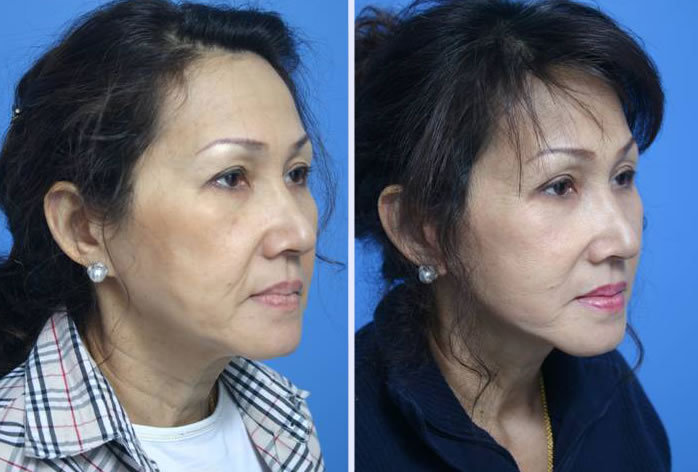 Before and After Image: facelift and mini facelift – case 10 - right-front-oblique