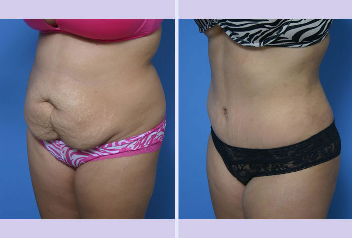 Before and After Image: abdominoplasty – tummy tuck – Case 11 - left-front-oblique