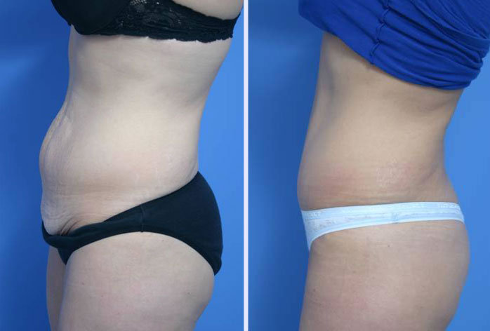 Before and After Image: abdominoplasty – tummy tuck – Case 10 - left-side
