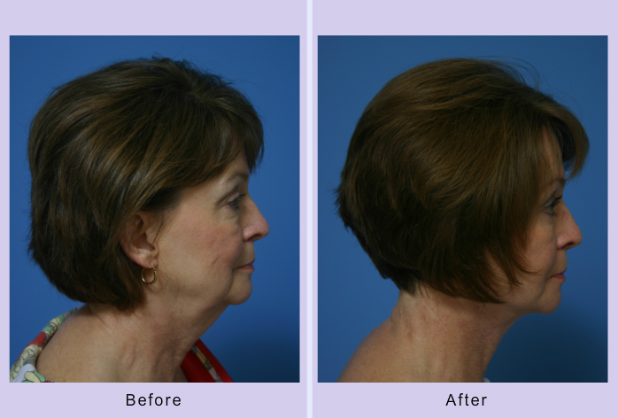 Before and After Image: facelift and mini facelift – case 5 - front