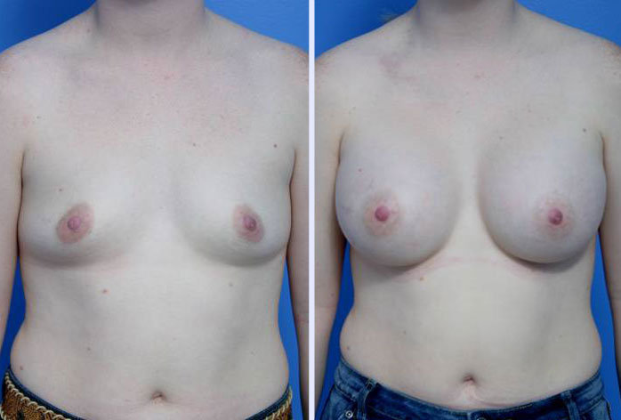 Before and After Image: breast augmentation – Case 3 - front