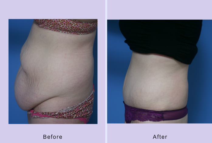 Before and After Image: abdominoplasty – tummy tuck – Case 26 - left-side