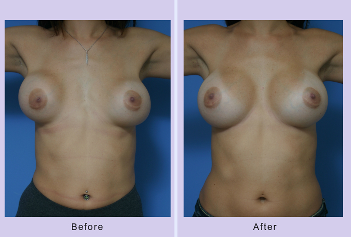 Before and After Image: breast correction – case 11 - front