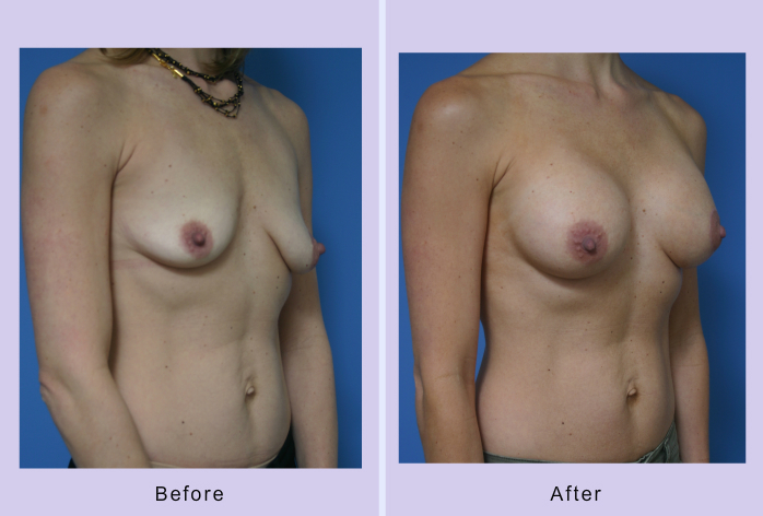 Before and After Image: breast lift – case 8 - right-front-oblique
