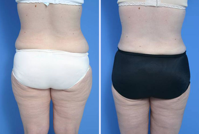 Before and After Image: liposuction – case 5 - back