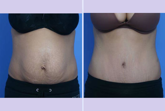 Before and After Image: abdominoplasty – tummy tuck – Case 7 - front