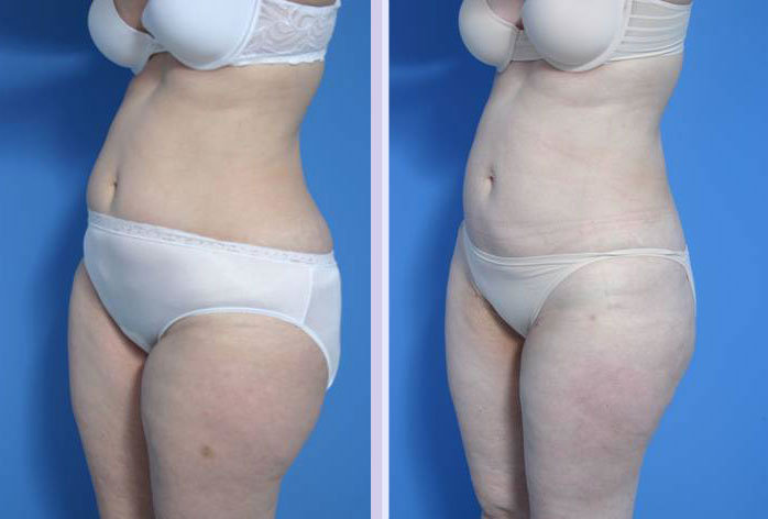 Before and After Image: liposuction – case 3 - left-front-oblique