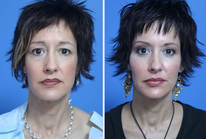 Before and After Image: facial fat grafting – case 3 - front
