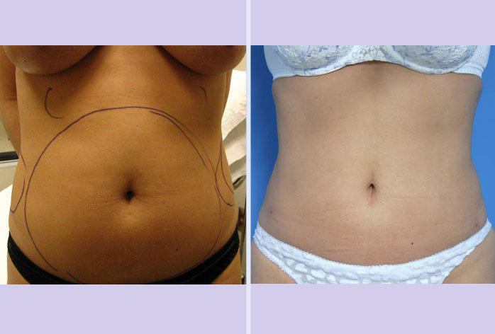 Before and After Image: liposuction – case 9 - front