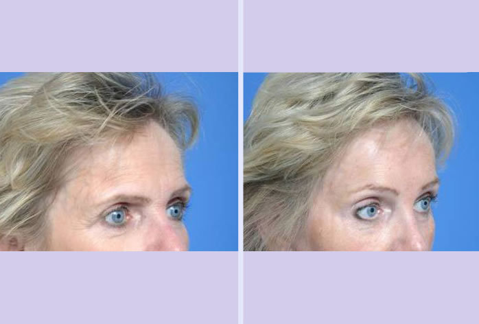 Before and After Image: browlift – case 1 - front