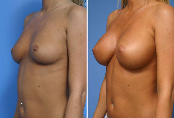 Before and After Image: breast augmentation – Case 13 - left-front-oblique