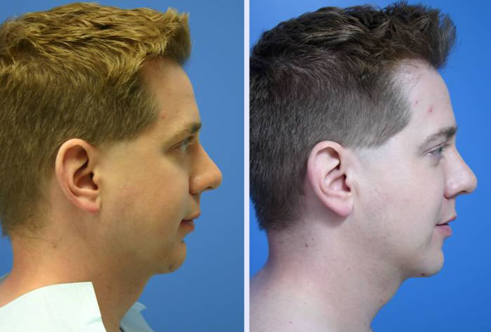Before and After Image: buccal lipectomy – case 2 - right-side