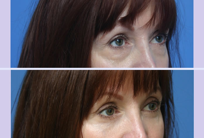 Before and After Image: blepharoplasty – case 8 - right-front-oblique