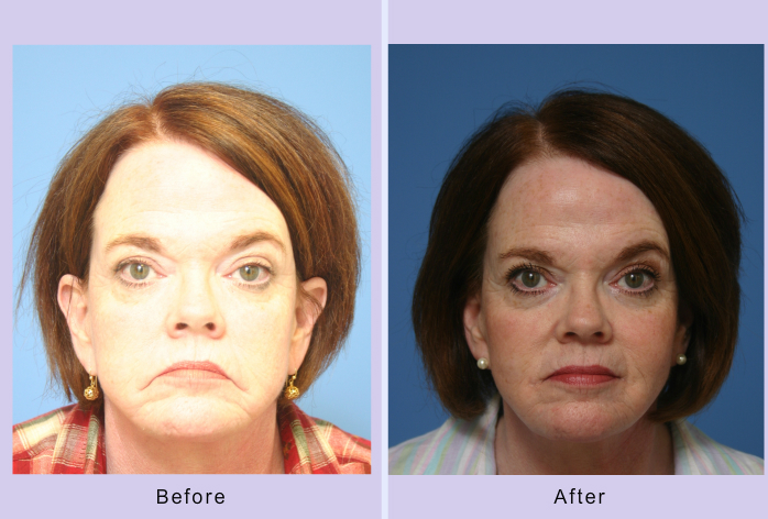 Before and After Image: grin lift – case 1 - front