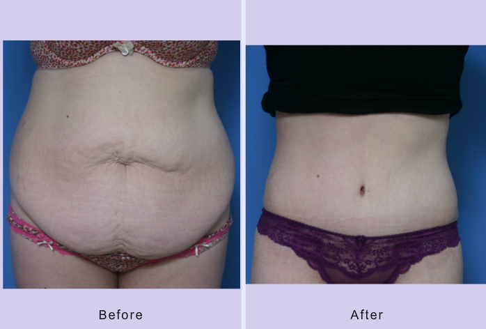Before and After Image: abdominoplasty – tummy tuck – Case 26 - front