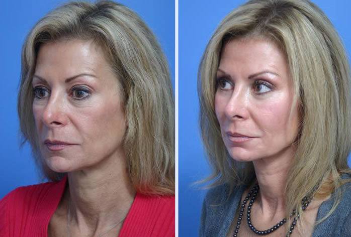 Before and After Image: facial fat grafting – case 7 - left-front-oblique
