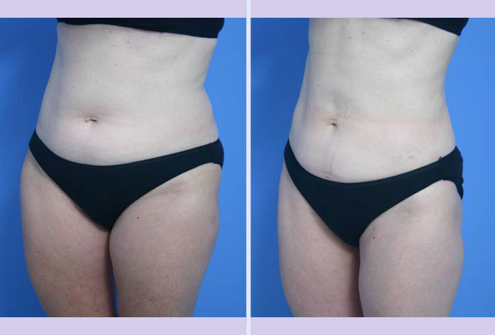 Before and After Image: liposuction – case 13 - left-front-oblique