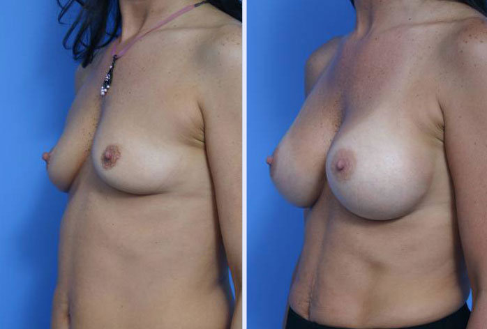 Before and After Image: breast augmentation – Case 8 - left-front-oblique