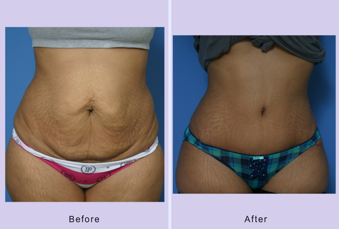 Before and After Image: abdominoplasty – tummy tuck – Case 19 - front