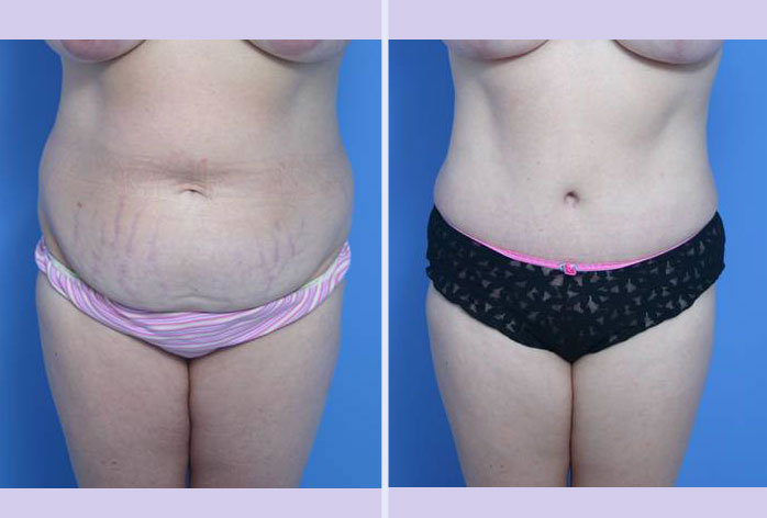 Before and After Image: abdominoplasty – tummy tuck – Case 20 - front