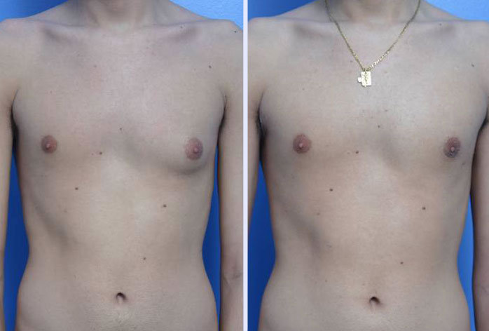 Before and After Image: gynecomastia – case 1 - front