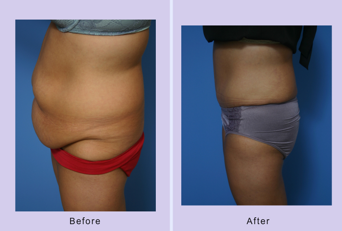 Before and After Image: abdominoplasty – tummy tuck – Case 16 - left-side