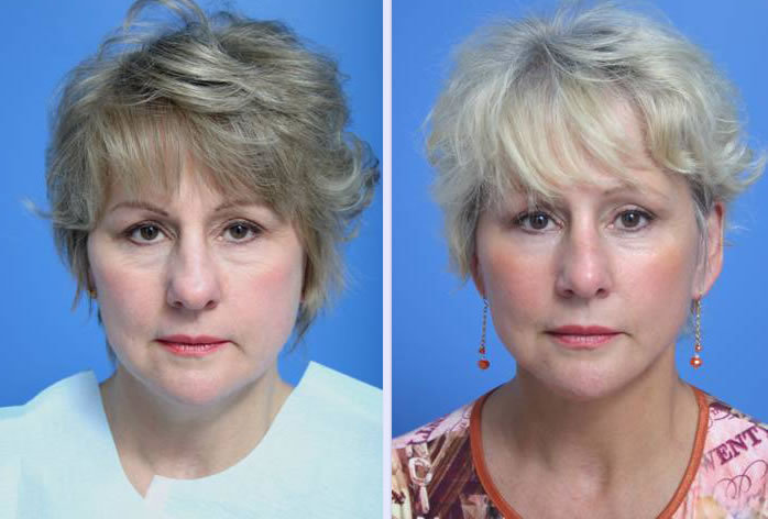 Before and After Image: 3-d volumetric facelift – case 4 - front
