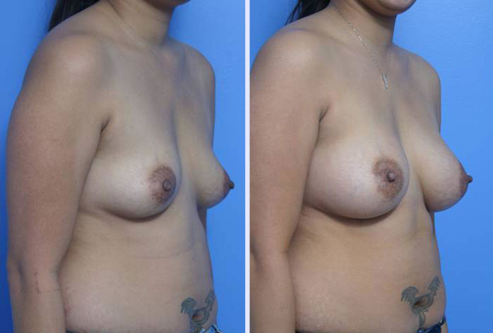 Before and After Image: breast augmentation – Case 16 - right-front-oblique