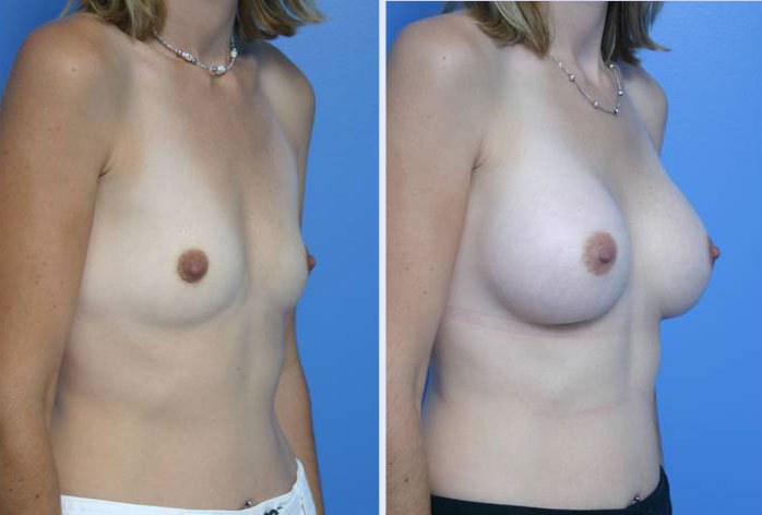 Before and After Image: breast augmentation – Case 5 - right-front-oblique