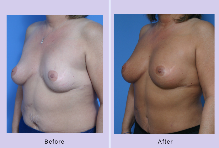 Before and After Image: breast correction – case 8 - left-front-oblique