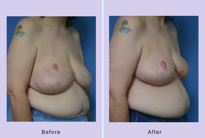 Before and After Image: breast reduction – case 6 - right-front-oblique