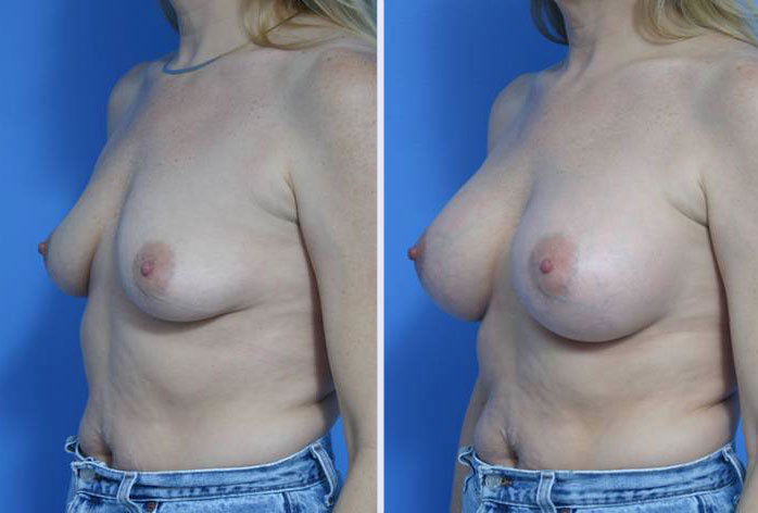 Before and After Image: breast augmentation – Case 6 - left-front-oblique