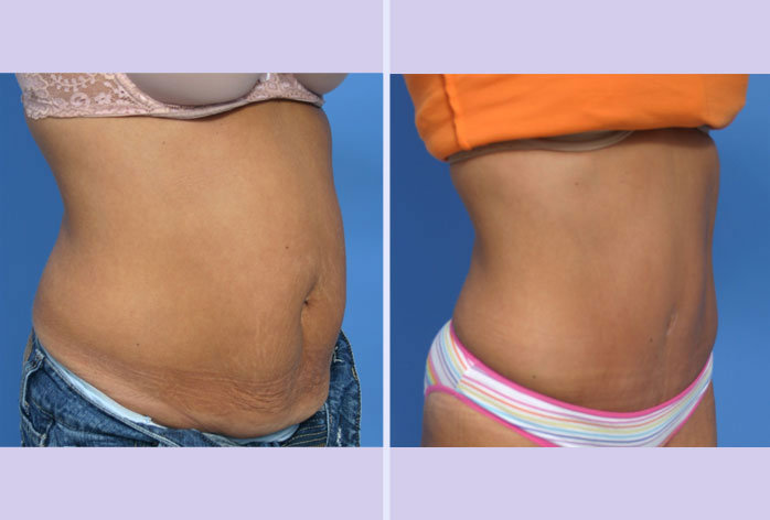 Before and After Image: abdominoplasty – tummy tuck – Case 13 - right-front-oblique