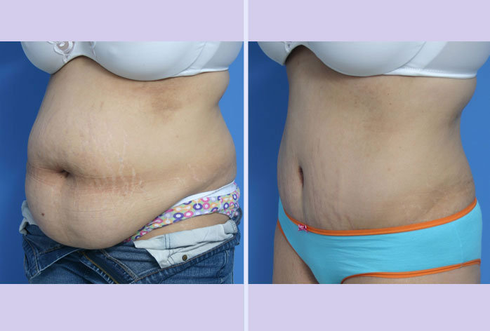 Before and After Image: abdominoplasty – tummy tuck – Case 12 - left-front-oblique