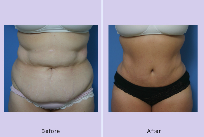 Before and After Image: abdominoplasty – tummy tuck – Case 3 - front