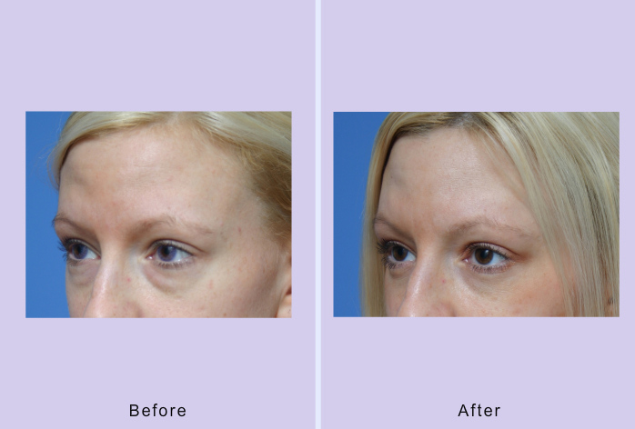 Before and After Image: blepharoplasty – case 10 - left-front-oblique