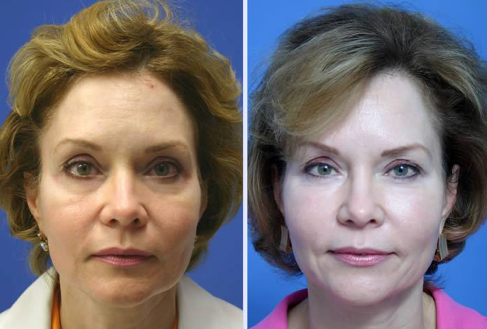 Before and After Image: facial fat grafting – case 5 - front