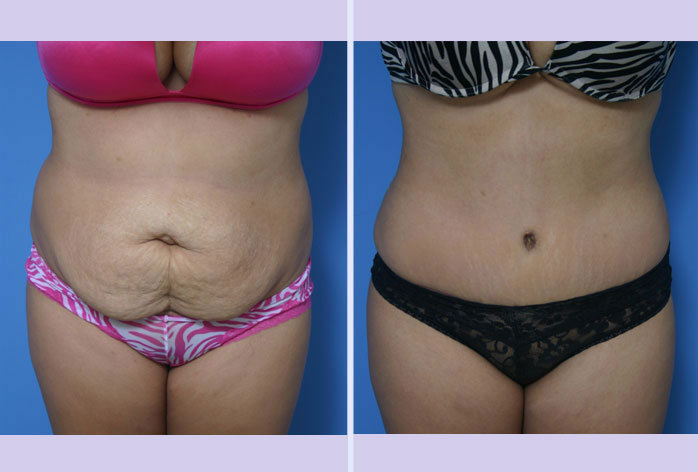 Before and After Image: abdominoplasty – tummy tuck – Case 11 - front