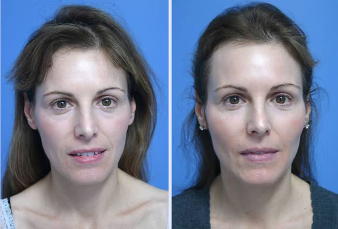 Before and After Image: facial fat grafting – case 9 - front