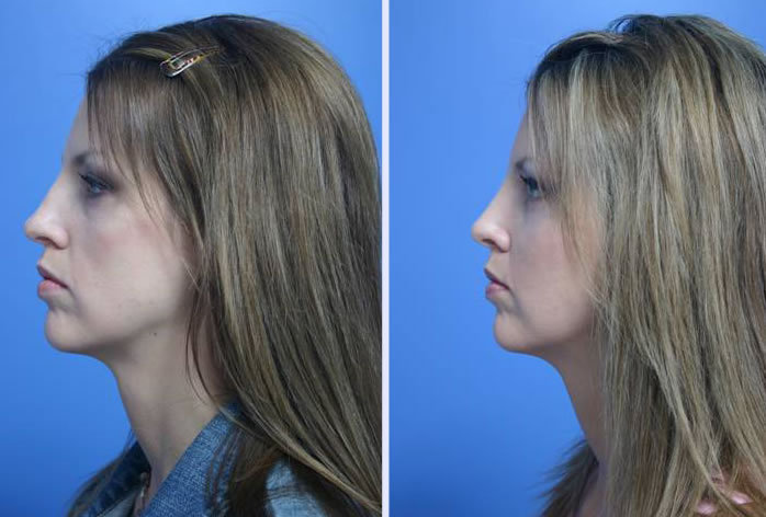 Before and After Image: facial fat grafting – case 8 - left-side