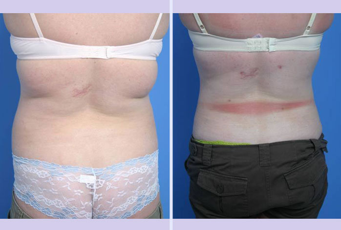 Before and After Image: liposuction – case 11 - back
