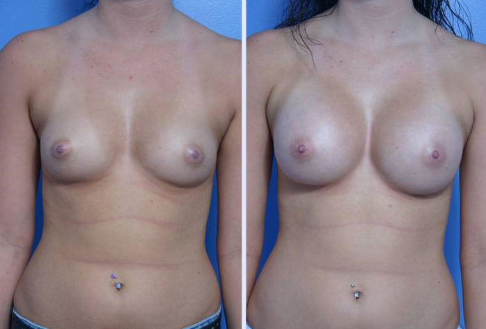 Before and After Image: breast augmentation – Case 12 - front