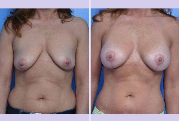 Before and After Image: breast lift – case 5 - front