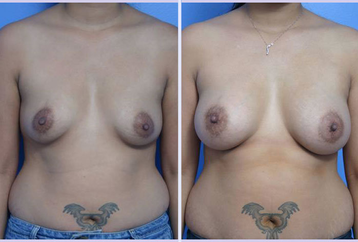 Before and After Image: breast augmentation – Case 16 - front